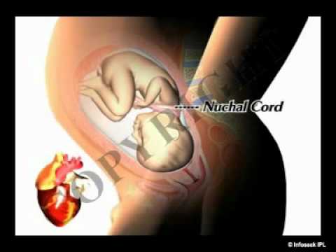 Health Video on Pregnancy Complications (Nuchal Cord)